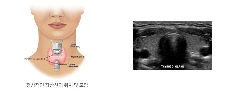 정상적인 갑상선의 위치 및 모양