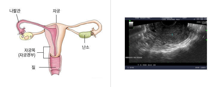 골반 초음파