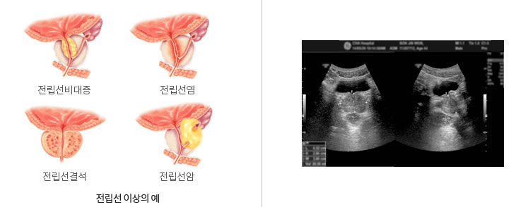 전립선 이상의 예